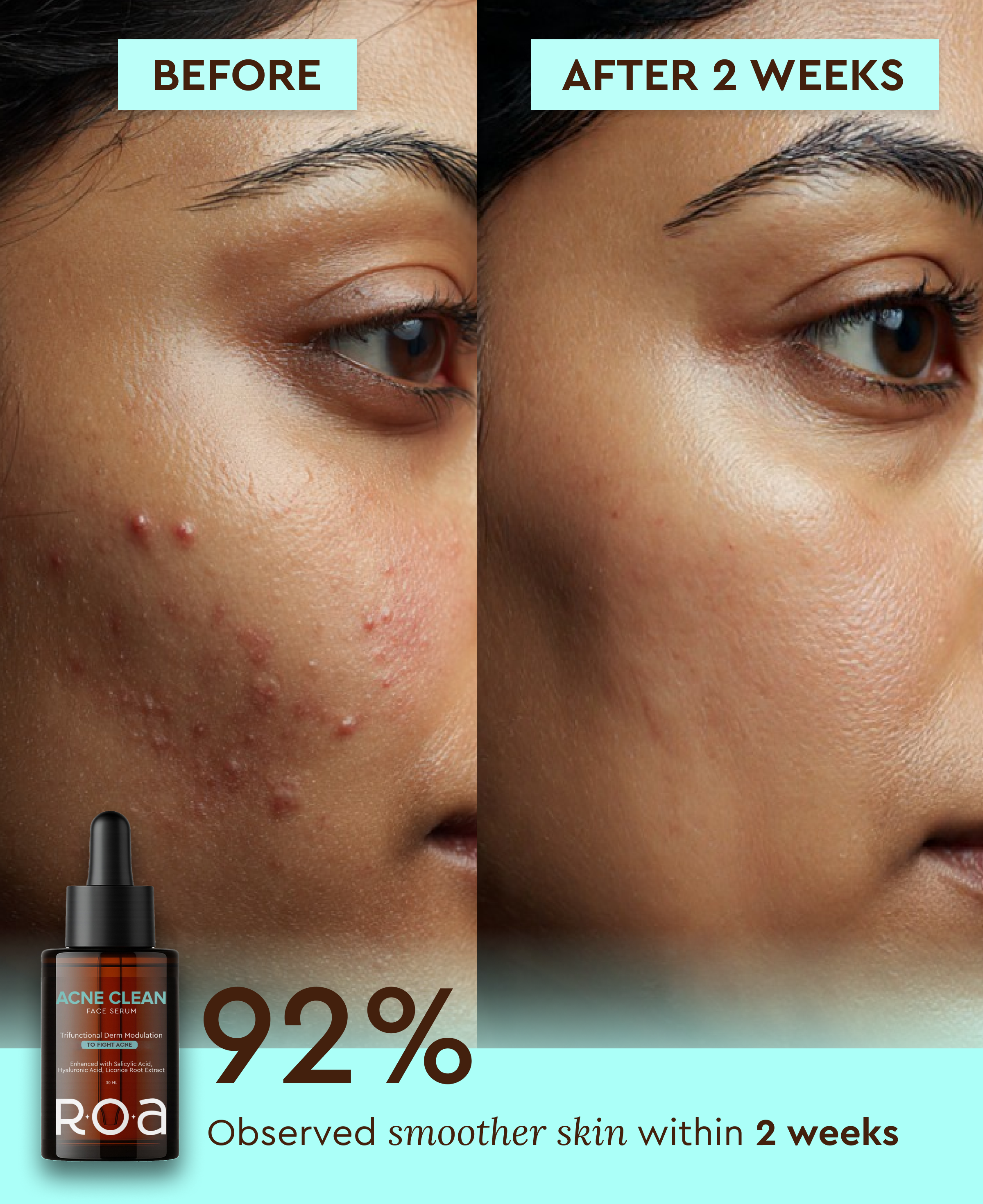 ACNE CLEAN 2% SALICYLIC ACID SERUM