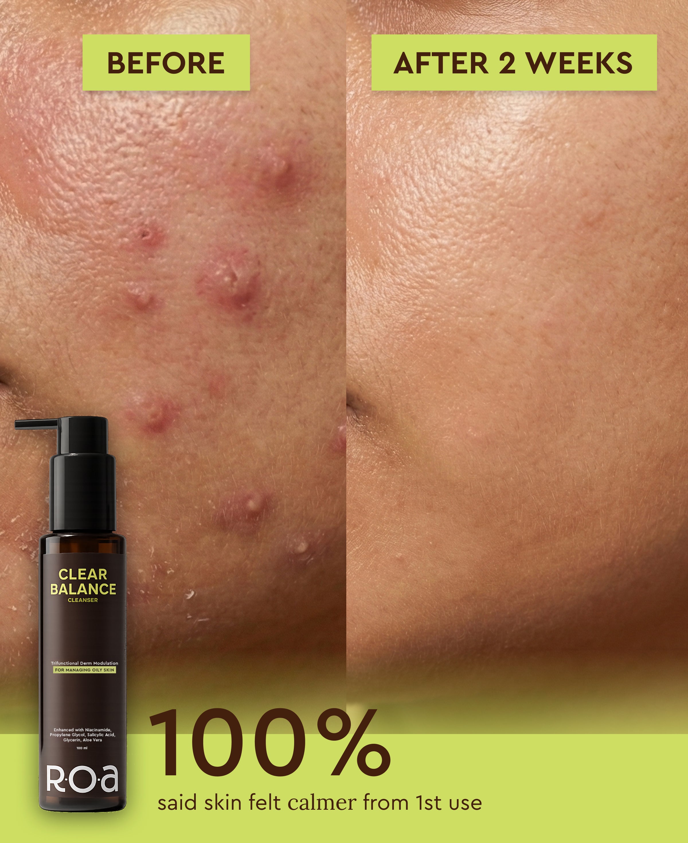 ROA SKINCARE CLEAR BALANCE CLEANSER FOR OILY ACNE PRONE SKIN