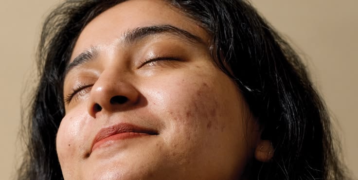 white acne on face