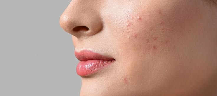 skin care routine for acne prone skin